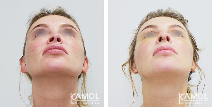 Before and After Augmentation Rhinoplasty, Nose Job, Nose Surgery  with Rib Cartilage