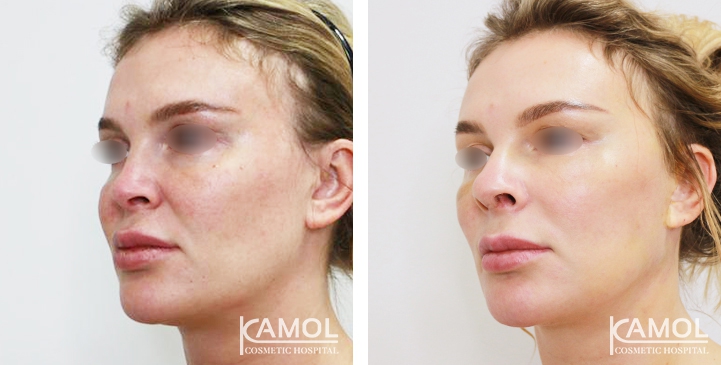 Before and After Augmentation Rhinoplasty, Nose Job, Nose Surgery  with Rib Cartilage