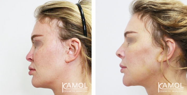 Before and After Augmentation Rhinoplasty, Nose Job, Nose Surgery  with Rib Cartilage