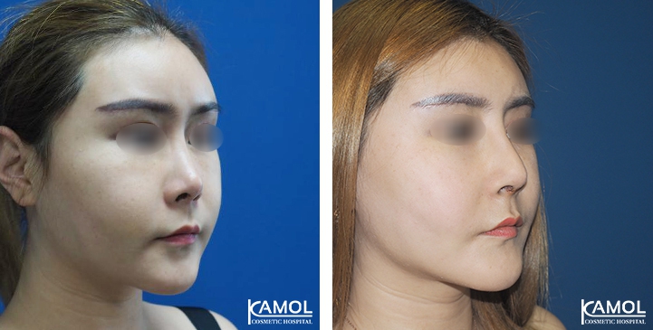 Before and After Augmentation Rhinoplasty, Nose Job, Nose Surgery  with Rib Cartilage