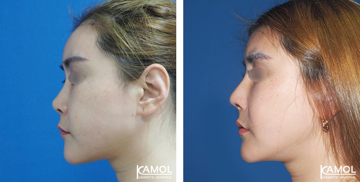 Before and After Augmentation Rhinoplasty, Nose Job, Nose Surgery  with Rib Cartilage