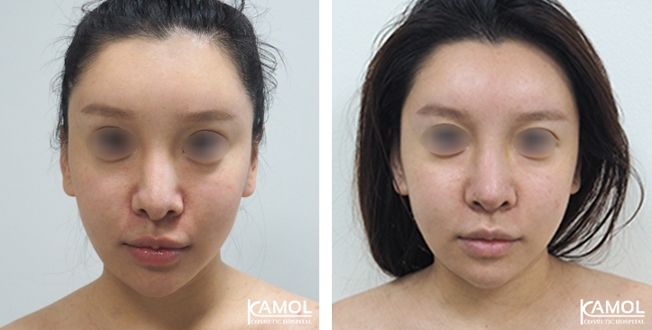 Before and After Augmentation Rhinoplasty, Nose Job, Nose Surgery  with Rib Cartilage