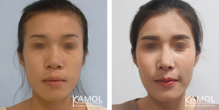 Before and After Augmentation Rhinoplasty, Nose Job, Nose Surgery  with e-PTFE Gore-Tex