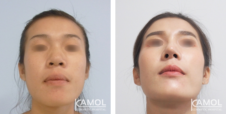 Before and After Augmentation Rhinoplasty, Nose Job, Nose Surgery  with e-PTFE Gore-Tex