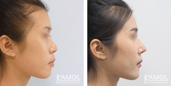 Before and After Augmentation Rhinoplasty, Nose Job, Nose Surgery  with e-PTFE Gore-Tex