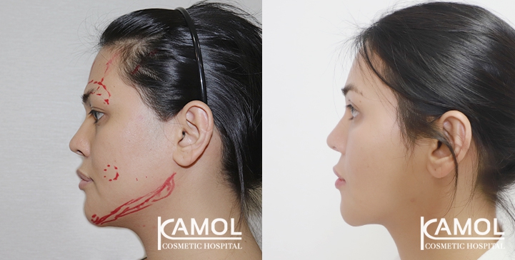 Jaw reduction, Forehead contouring, Eye brow lift