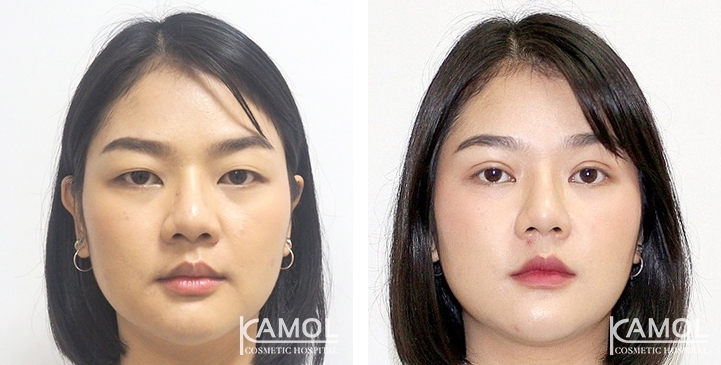 Double eyelid surgery