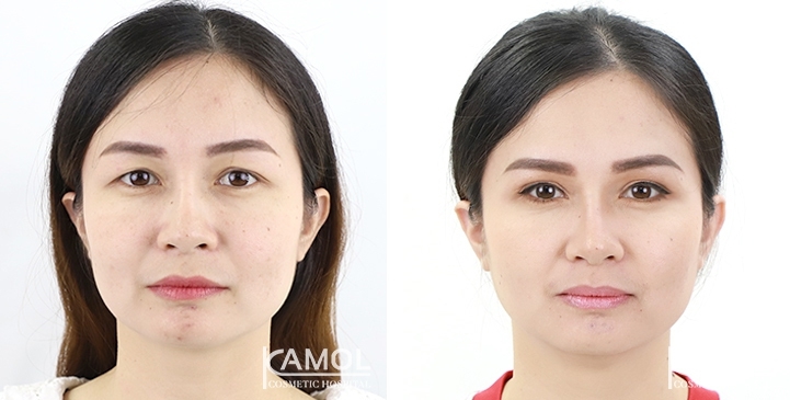 Eye Ptosis Surgery