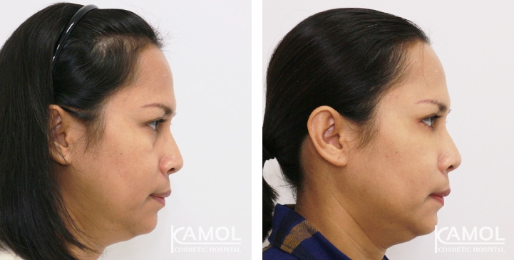 Lower Eyelid Surgery