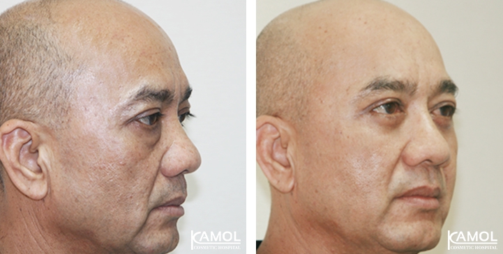 Lower Eyelid Surgery