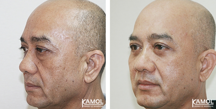 Lower Eyelid Surgery