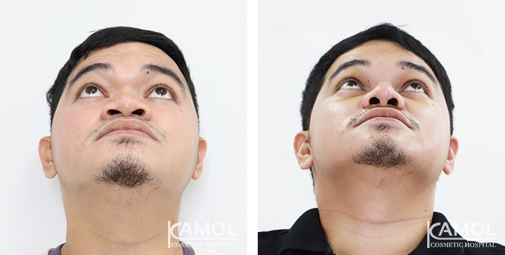 Before and After Augmentation Rhinoplasty, Nose Job, Nose Surgery