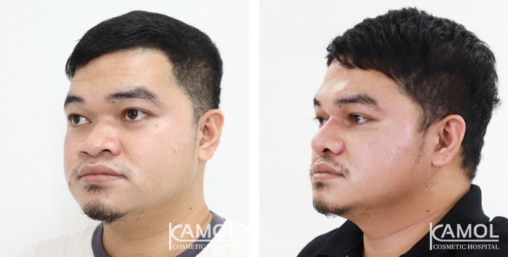 Before and After Augmentation Rhinoplasty, Nose Job, Nose Surgery