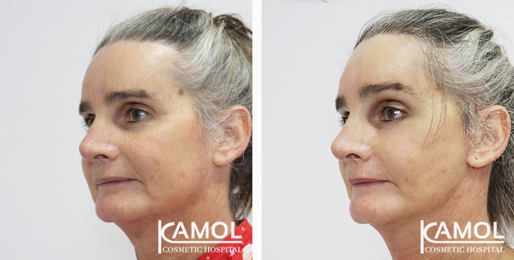 Before and After Full face lift, Neck lift