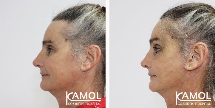 Before and After Full face lift, Neck lift