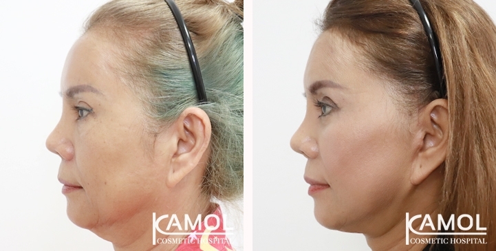 Before and After Full face lift, Neck lift