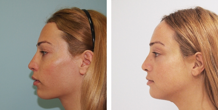 Before and After 1 month surgery, Forehead Compression, Chin Reduction, Jaw Reduction, Rhinoplasty