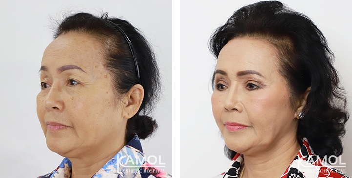 Before and After Full face lift, Neck lift