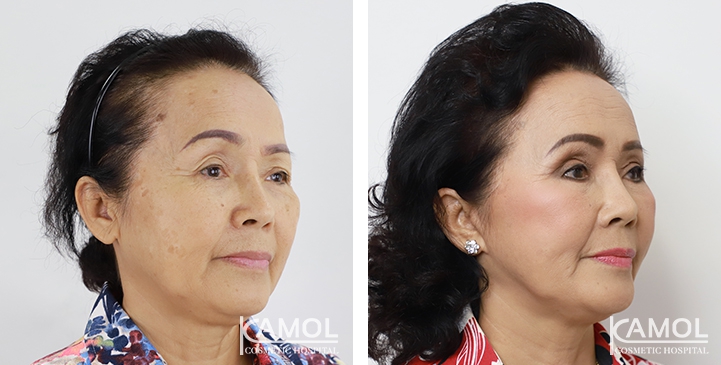 Before and After Full face lift, Neck lift