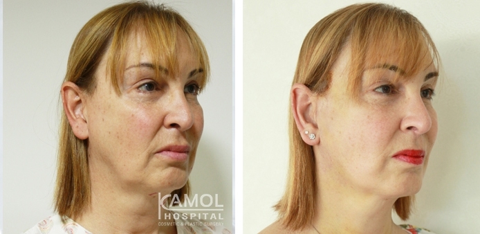 Before and After Full face lift, Neck lift