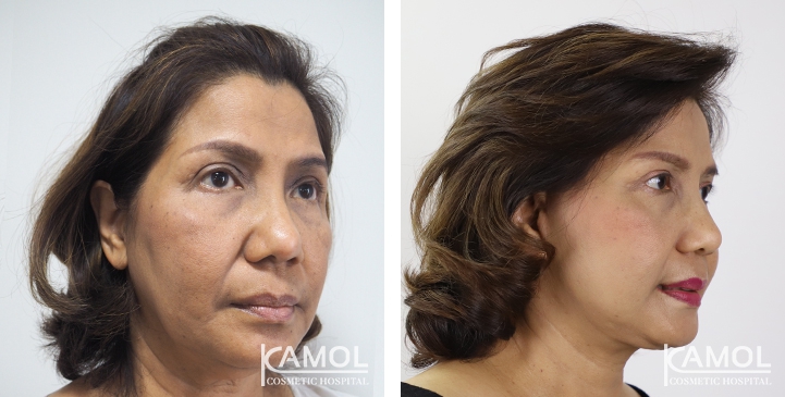 Before and After Full face lift, Neck lift