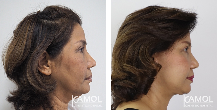 Before and After Full face lift, Neck lift