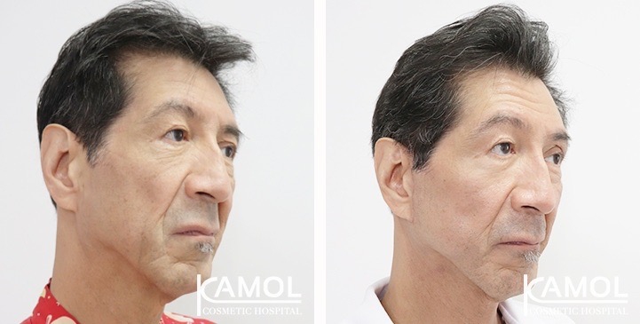 Before and After Full face lift, Neck lift