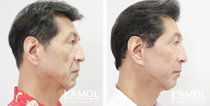 Before and After Full face lift, Neck lift