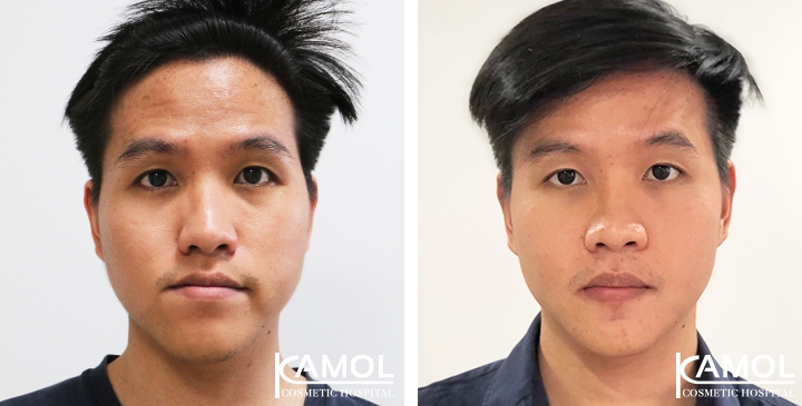 Before and After 1 month of Upper and Lower Mandibular Osteotomy, Corrective Jaw Surgery