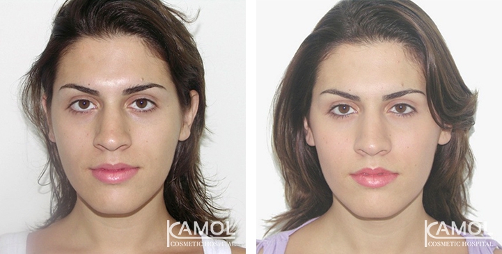 Before and After Jaw Augmentation