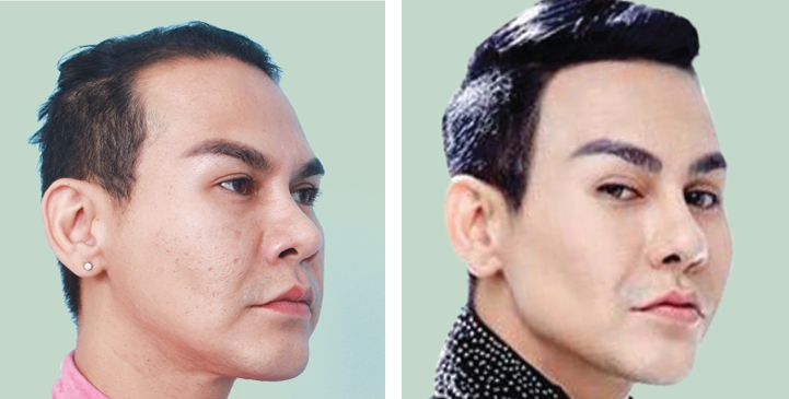 Before and After Jaw Augmentation