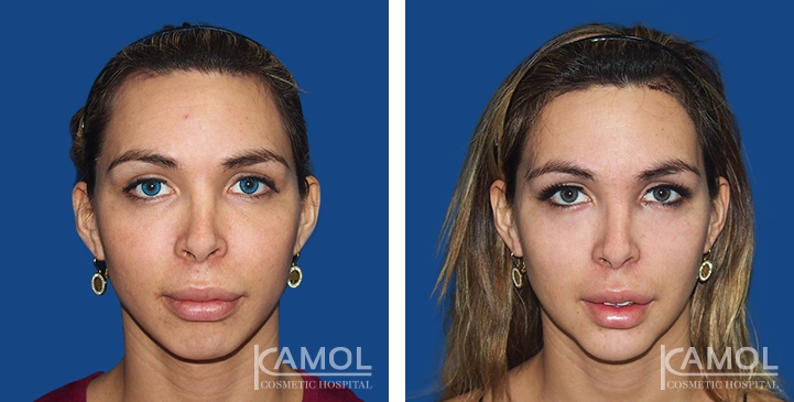 Before and After Jaw Reduction Surgery