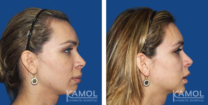 Before and After Jaw Reduction Surgery