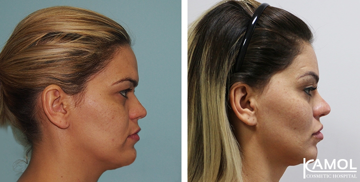 Before and After Jaw Reduction Surgery