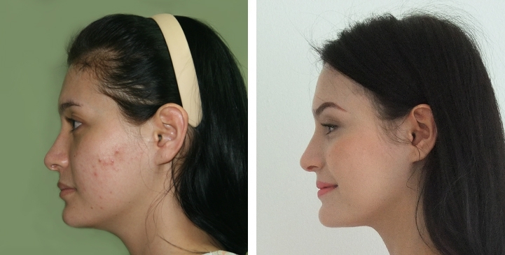 Before and After Jaw Reduction Surgery