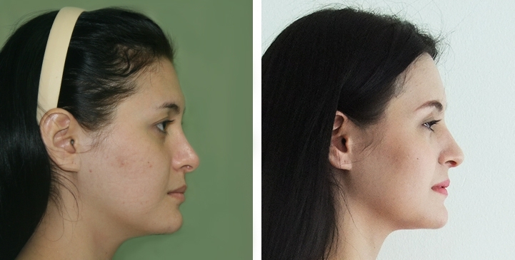 Before and After Jaw Reduction Surgery