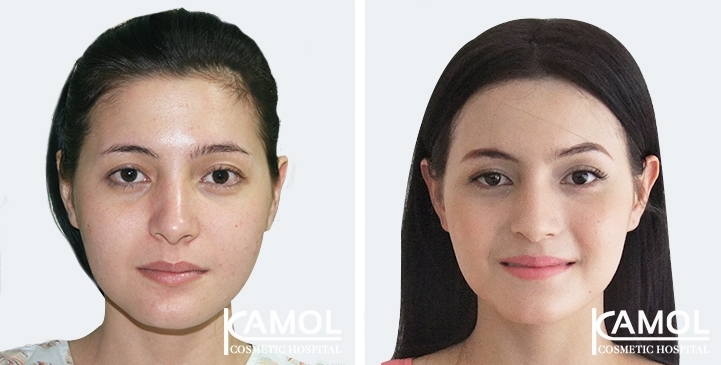 Forehead Augmentation