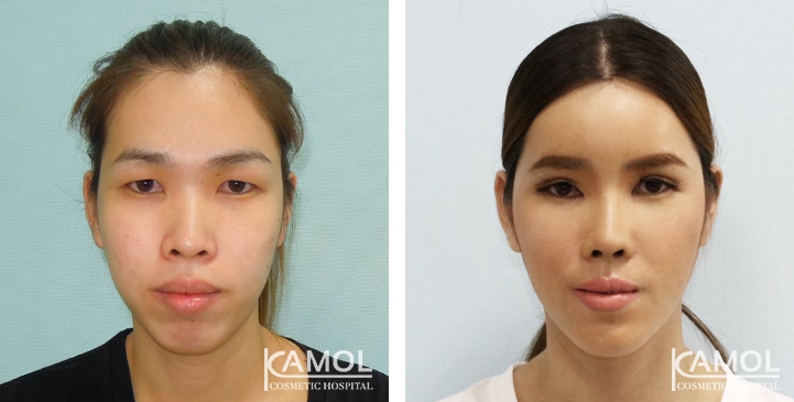 Before and After 1 month surgery, Forhead Augmentation, Cheekbone Reduction, Cheekbone Augmentation, Jaw Reduction, Rhinoplasty, Chin Forward Sliding