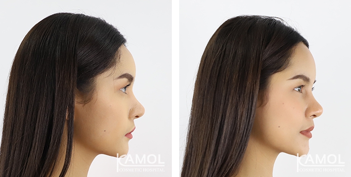 Before and After Forehead Augmentation