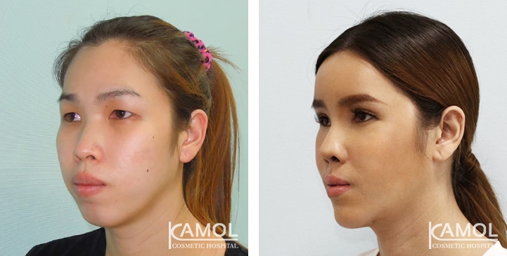 Before and After 1 month surgery, Forhead Augmentation, Cheekbone Reduction, Cheekbone Augmentation, Jaw Reduction, Rhinoplasty, Chin Forward Sliding