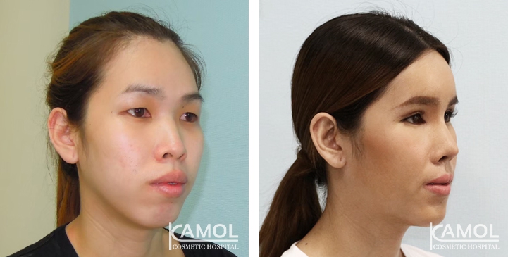 Before and After 1 month surgery, Forhead Augmentation, Cheekbone Reduction, Cheekbone Augmentation, Jaw Reduction, Rhinoplasty, Chin Forward Sliding