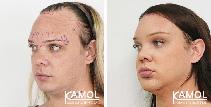 Hairline lowering, Forehead shaving, Forehead contouring type 3, Facial liposuction, Under chin liposuction