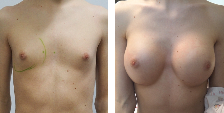 Male to Female Breast Surgery