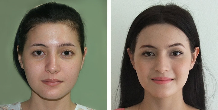 Before and After Cheekbone Reduction / Zygoma reduction