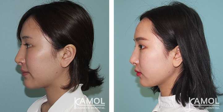 Before and After Cheekbone Reduction / Zygoma reduction