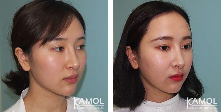 Before and After Cheekbone Reduction / Zygoma reduction