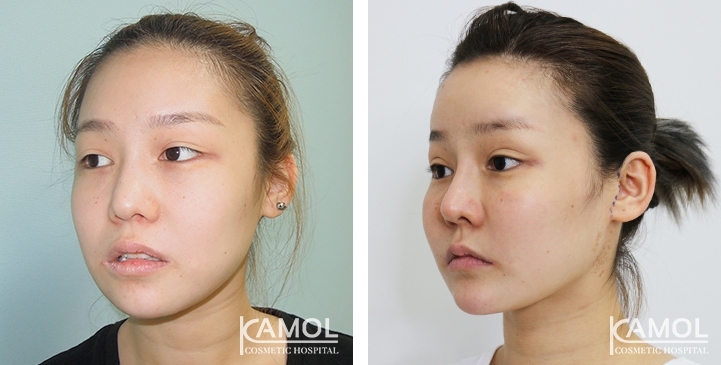 Before and After Cheekbone Reduction / Zygoma reduction