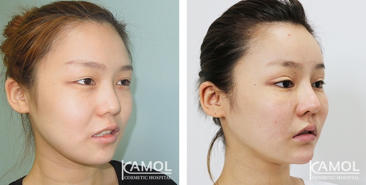 Before and After Cheekbone Reduction / Zygoma reduction