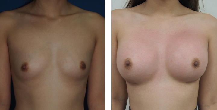 Male to Female Breast Surgery