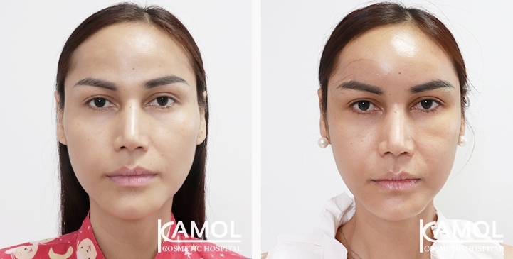 Before and After Cheekbone Augmentation